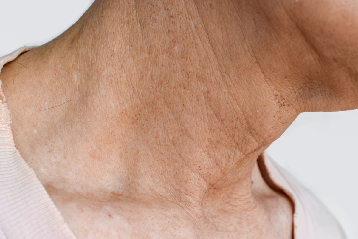 manchas no pescoco