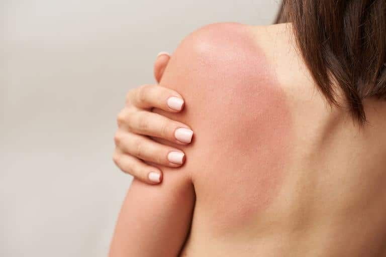 regenerar pele queimada-1