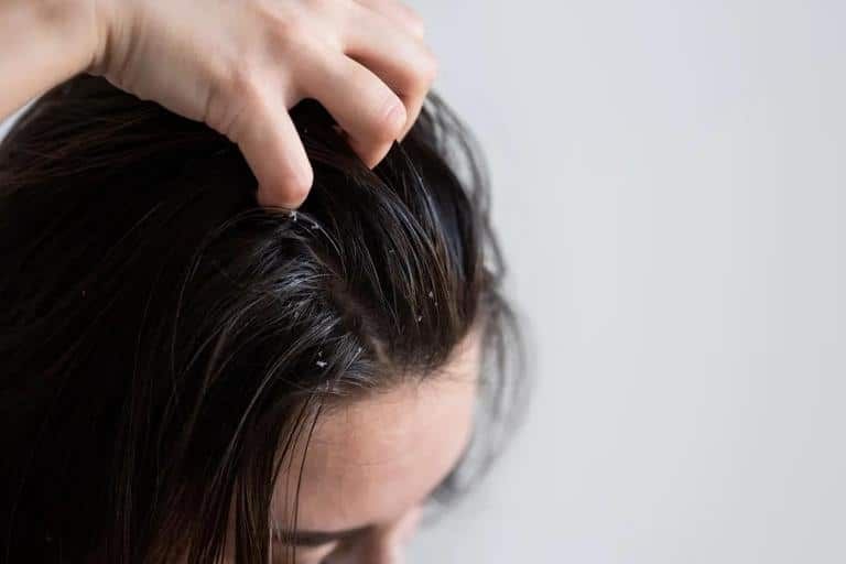 caspa cabelo oleoso