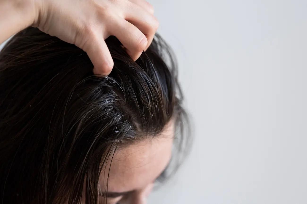 caspa cabelo oleoso