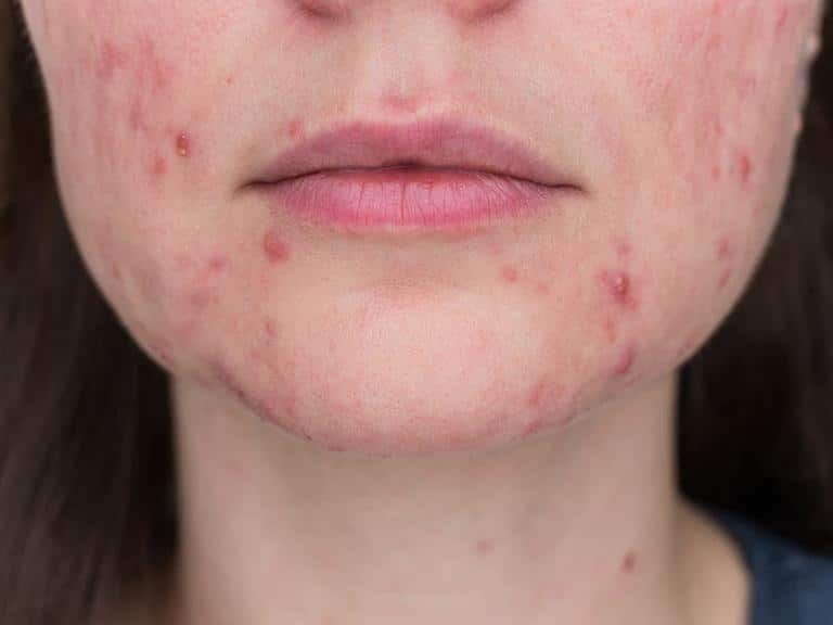 borbulhas hormonais