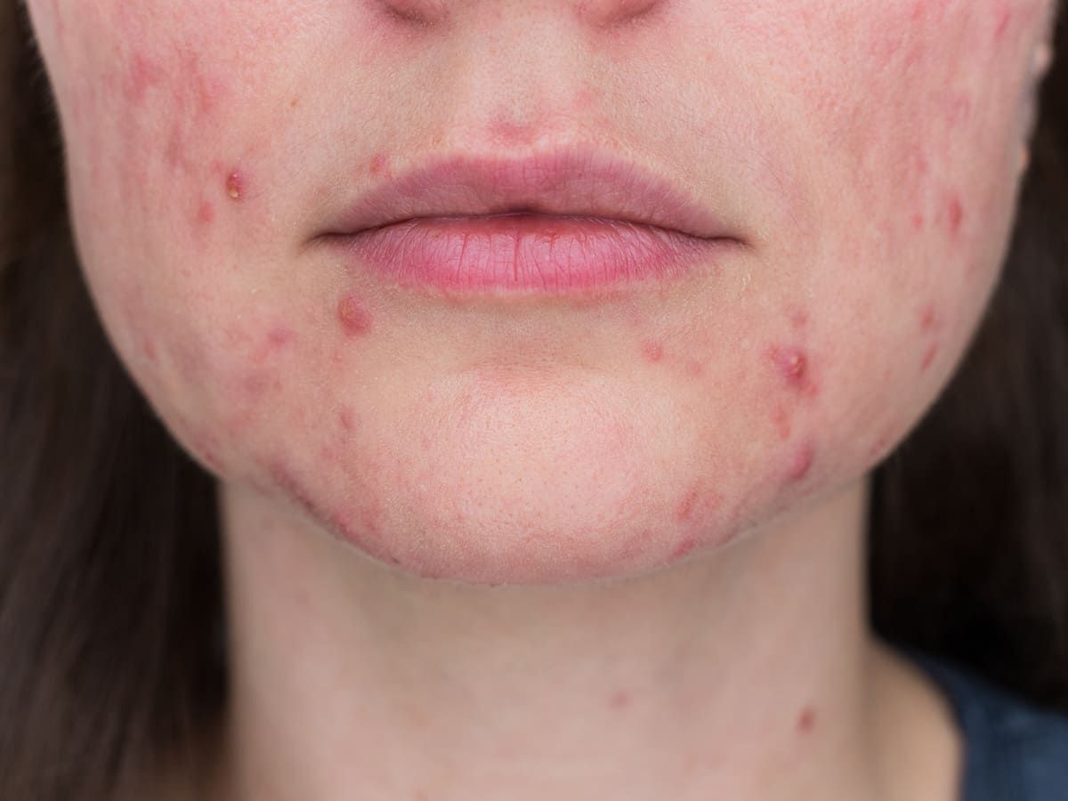 borbulhas hormonais